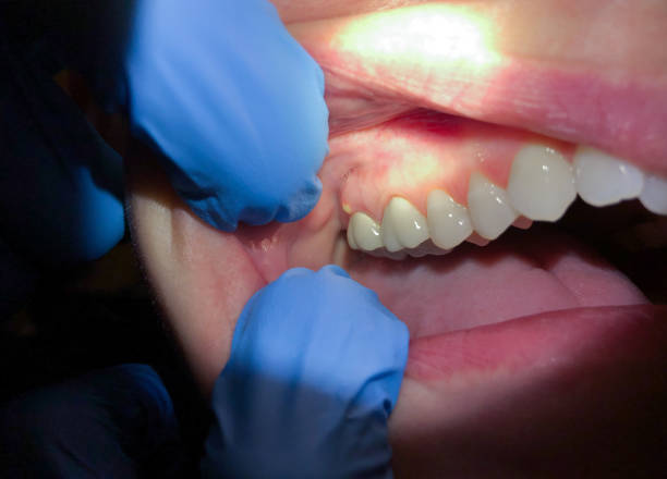 Best Emergency Tooth Extraction in Crenshaw, MS